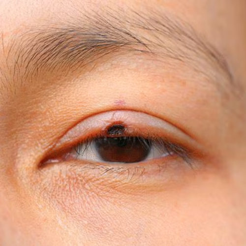 Optic Nerve Conditions
